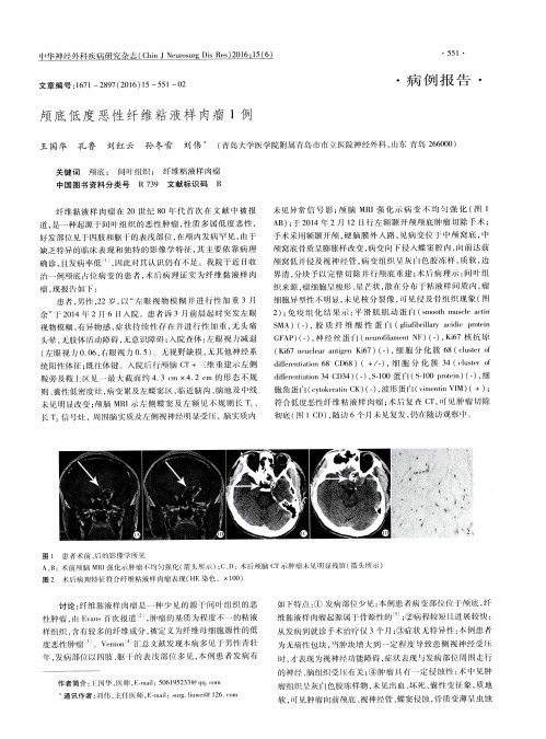 颅底低度恶性纤维粘液样肉瘤1例