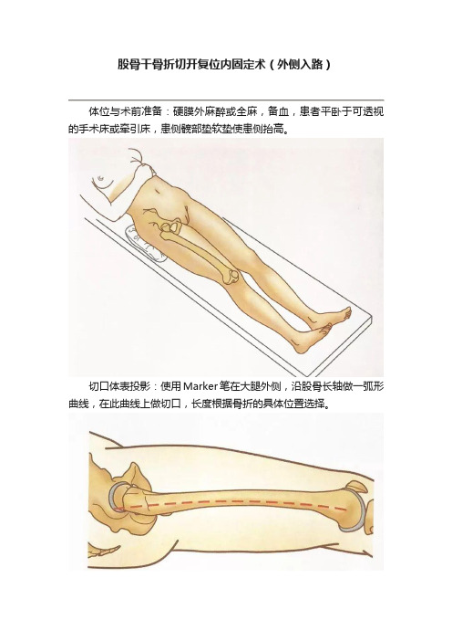 股骨干骨折切开复位内固定术（外侧入路）