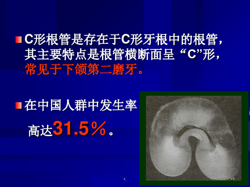 C形根管的形态识别和治疗.PPT