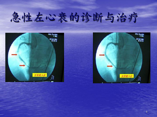 急性左心衰_图文PPT课件