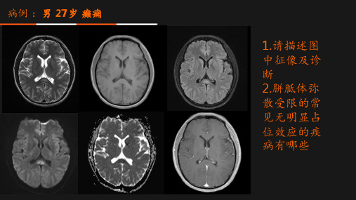 可逆性胼胝体压部病变综合征(RESLES)的诊断及MR表现【影像科】 ppt课件