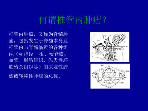 常见椎管内肿瘤及MRI表现