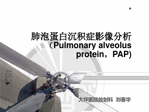 肺泡蛋白沉积症 .ppt