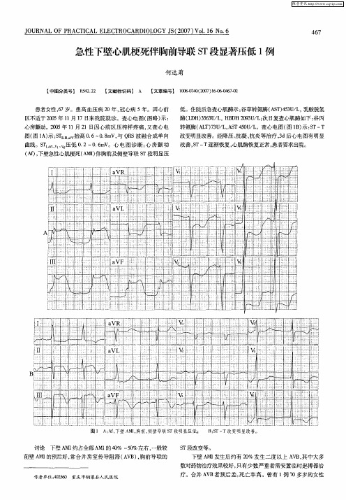 急性下壁心肌梗死伴胸前导联ST段显著压低1例