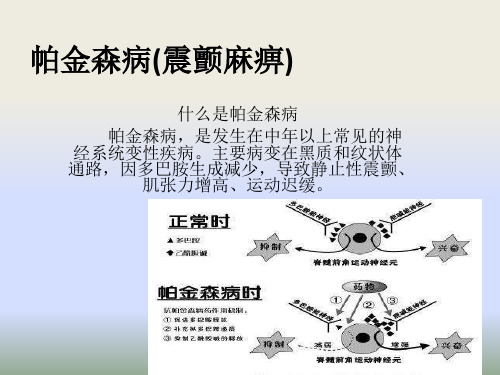 帕金森病(震颤麻痹)PPT