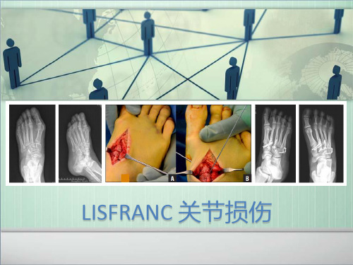 Lisfranc损伤的诊断与治疗