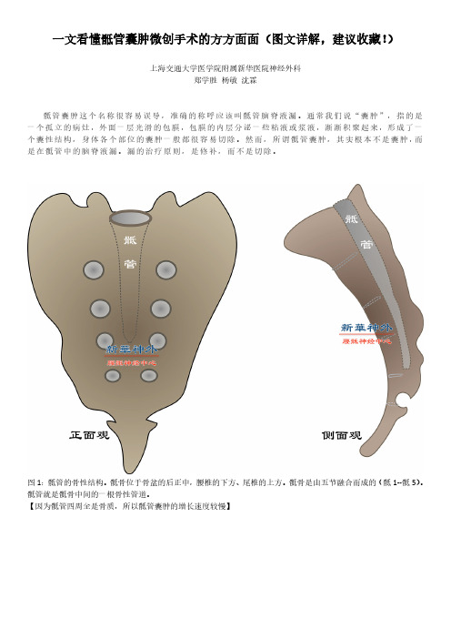 一文看懂骶管囊肿微创手术的方方面面(图文详解,建议收藏!)