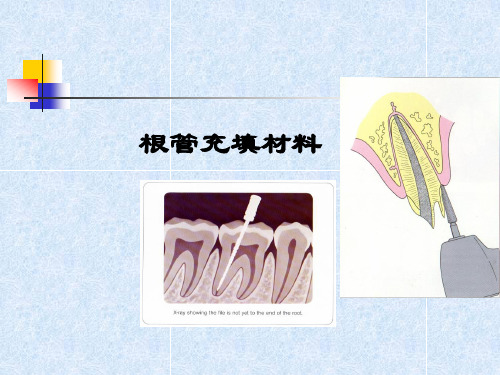 根管充填材料课件