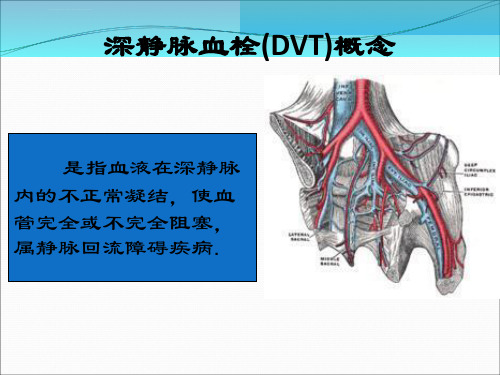 深静脉血栓的评估要点ppt课件