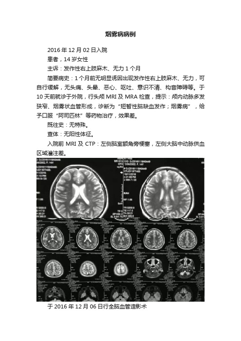 烟雾病病例