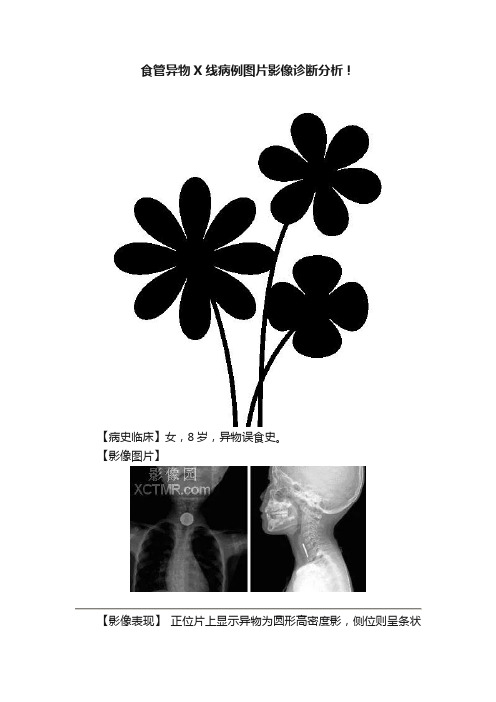 食管异物X线病例图片影像诊断分析！