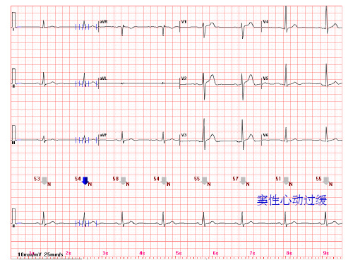心电图常见正常和异常心电图图谱