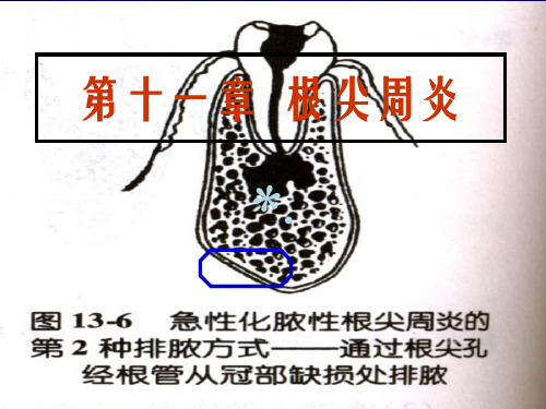 根尖周炎ppt课件