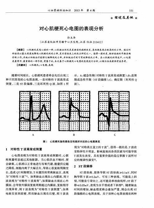 对心肌梗死心电图的表现分析