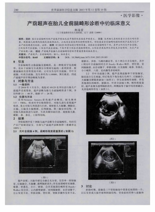 产前超声在胎儿全前脑畸形诊断中的临床意义