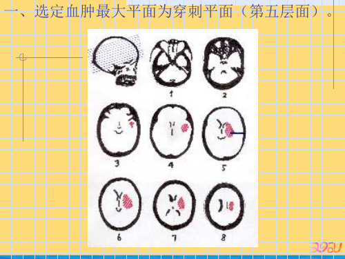 颅内血肿CT片定位穿刺技巧PPT推荐版