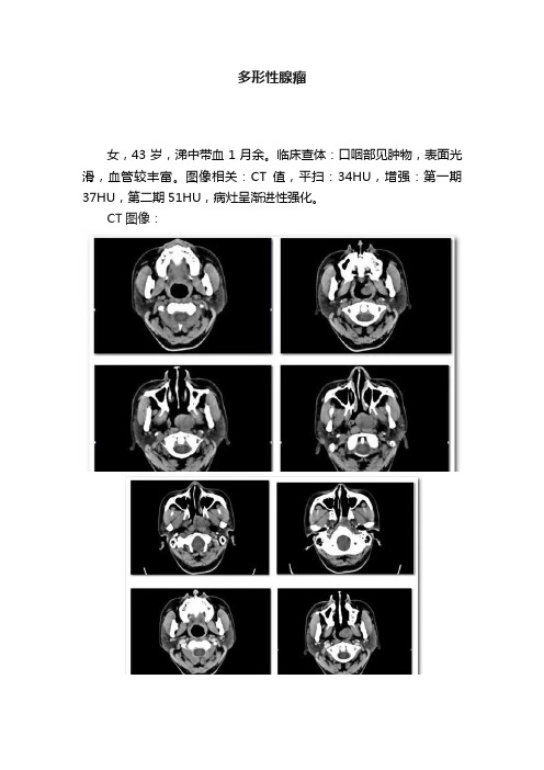 多形性腺瘤