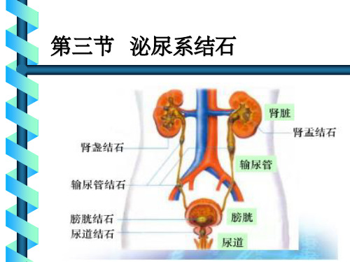 泌尿系结石 (2)ppt课件