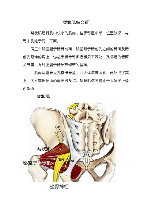 梨状肌综合征