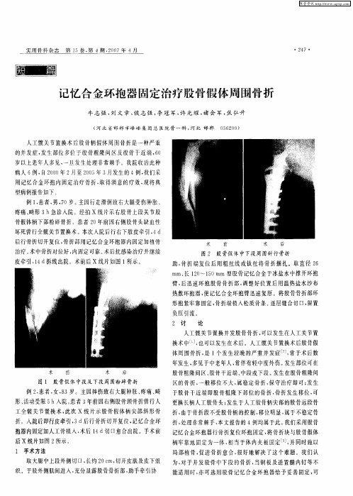 记忆合金环抱器固定治疗股骨假体周围骨折