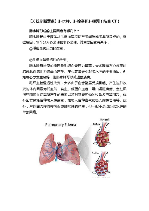 【X线诊断要点】肺水肿、肺栓塞和肺梗死（结合CT）