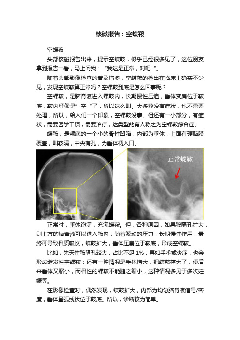 核磁报告：空蝶鞍