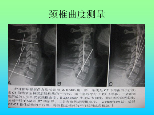 常用脊柱测量方法及其临床意义