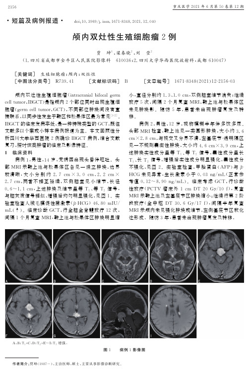 颅内双灶性生殖细胞瘤2例