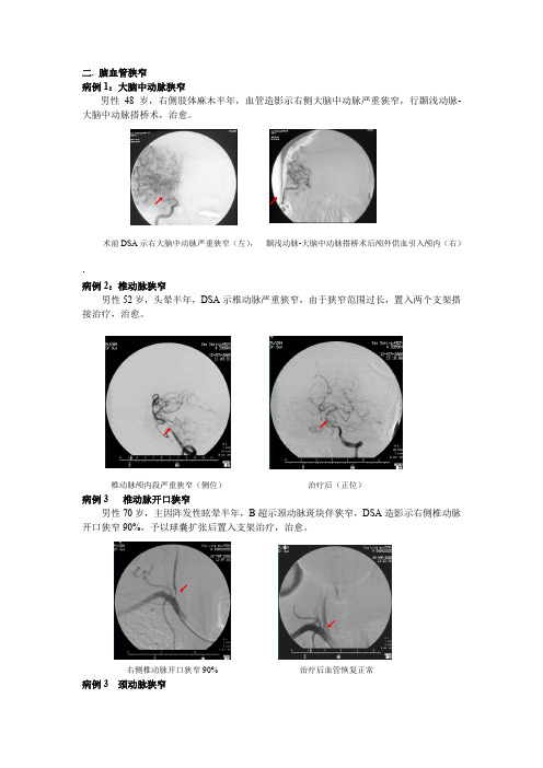 二.脑血管狭窄