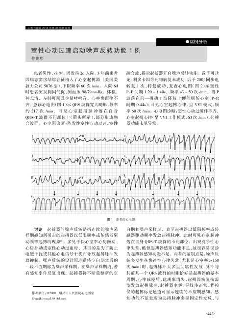 室性心动过速启动噪声反转功能1例