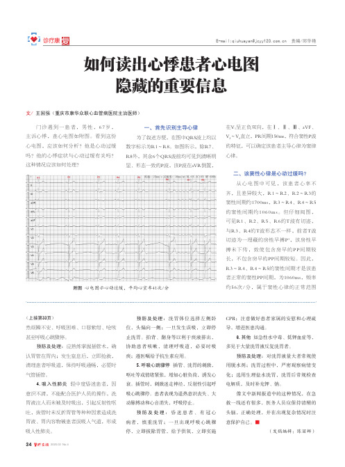 如何读出心悸患者心电图隐藏的重要信息