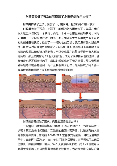 射频美容做了五次的我崩溃了,射频的副作用太惨了