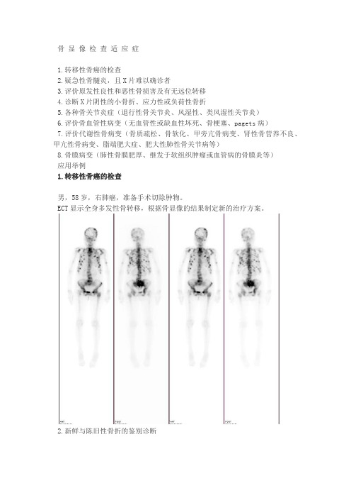 ECT骨显象的临床应用