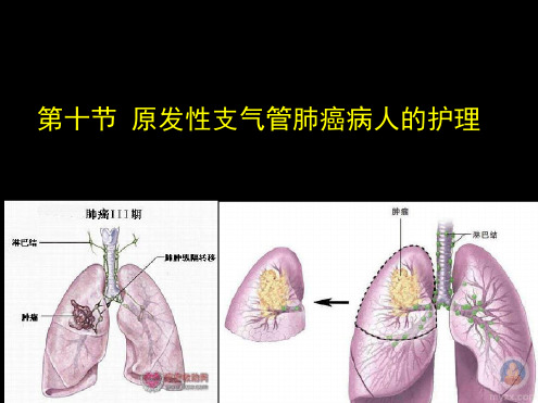 原发性支气管肺癌病人的护理