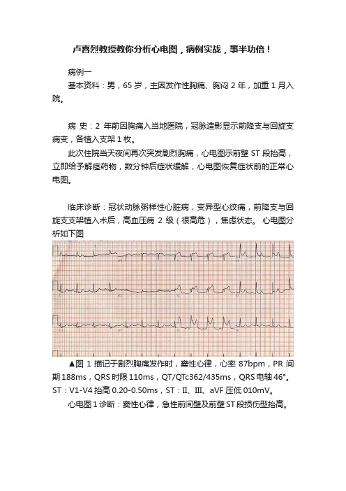 卢喜烈教授教你分析心电图，病例实战，事半功倍！