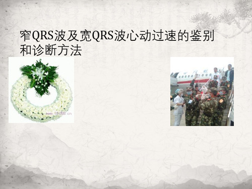 窄QRS波及宽QRS波心动过速鉴别与诊断方法