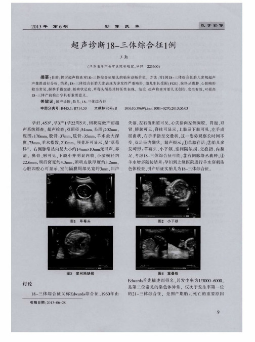 超声诊断18-三体综合征1例