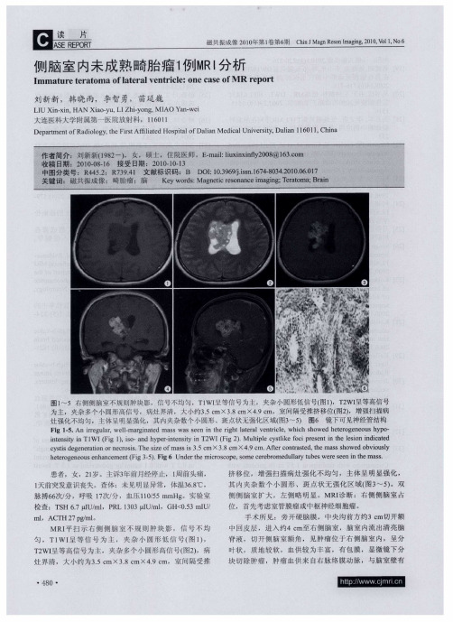 侧脑室内未成熟畸胎瘤1例MRI分析