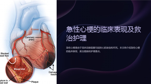 急性心梗的临床表现及救治护理