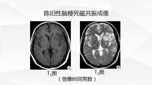 12 第四章 第一节 自旋回波信号与加权图像