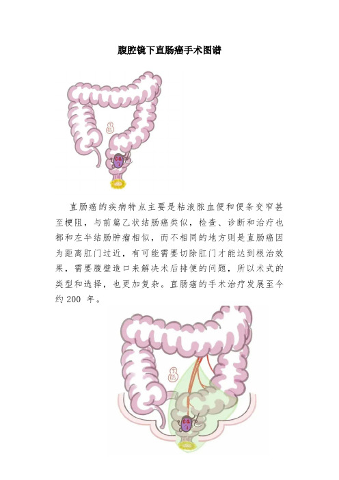 腹腔镜下直肠癌手术图谱