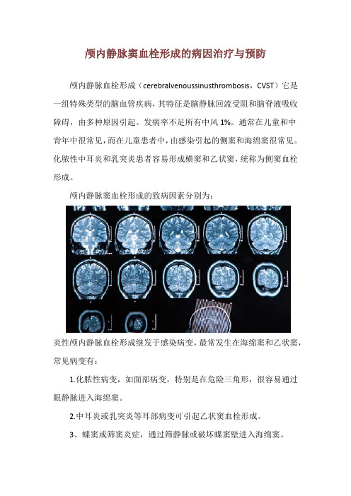 颅内静脉窦血栓形成的病因治疗与预防