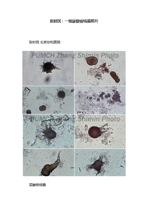 张时民：一组尿酸铵结晶照片