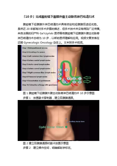 「10步」完成腹腔镜下腹膜外腹主动脉旁淋巴结清扫术