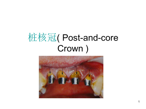 桩核冠 贴面