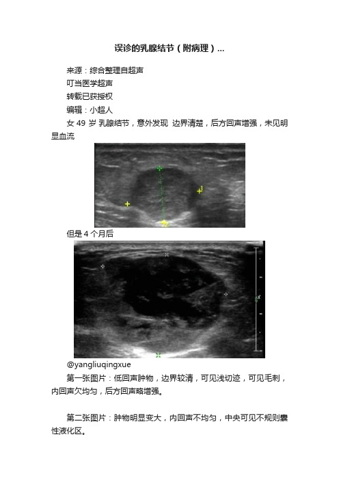 误诊的乳腺结节（附病理）...