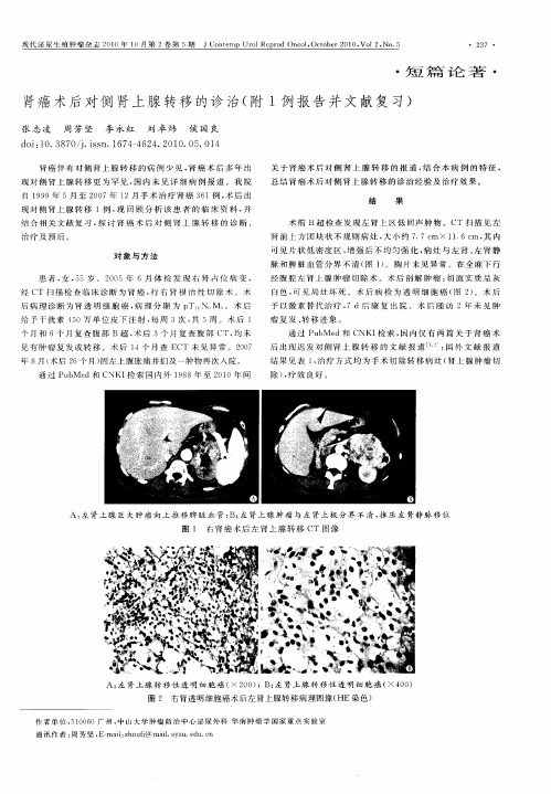 肾癌术后对侧肾上腺转移的诊治(附1例报告并文献复习)