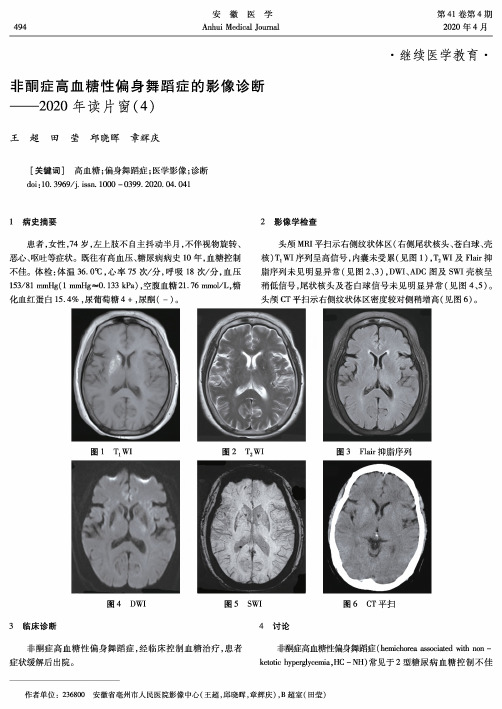 非酮症高血糖性偏身舞蹈症的影像诊断——2020年读片窗(4)