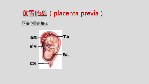 前置胎盘与胎盘植入影像表现