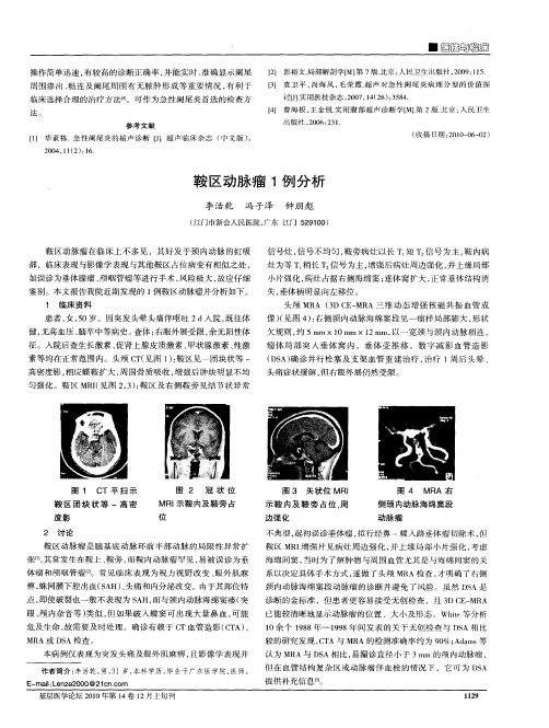 鞍区动脉瘤1例分析